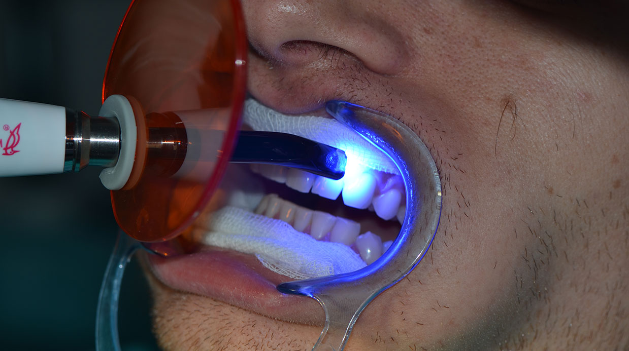 Izbeljivanje zuba laserom
